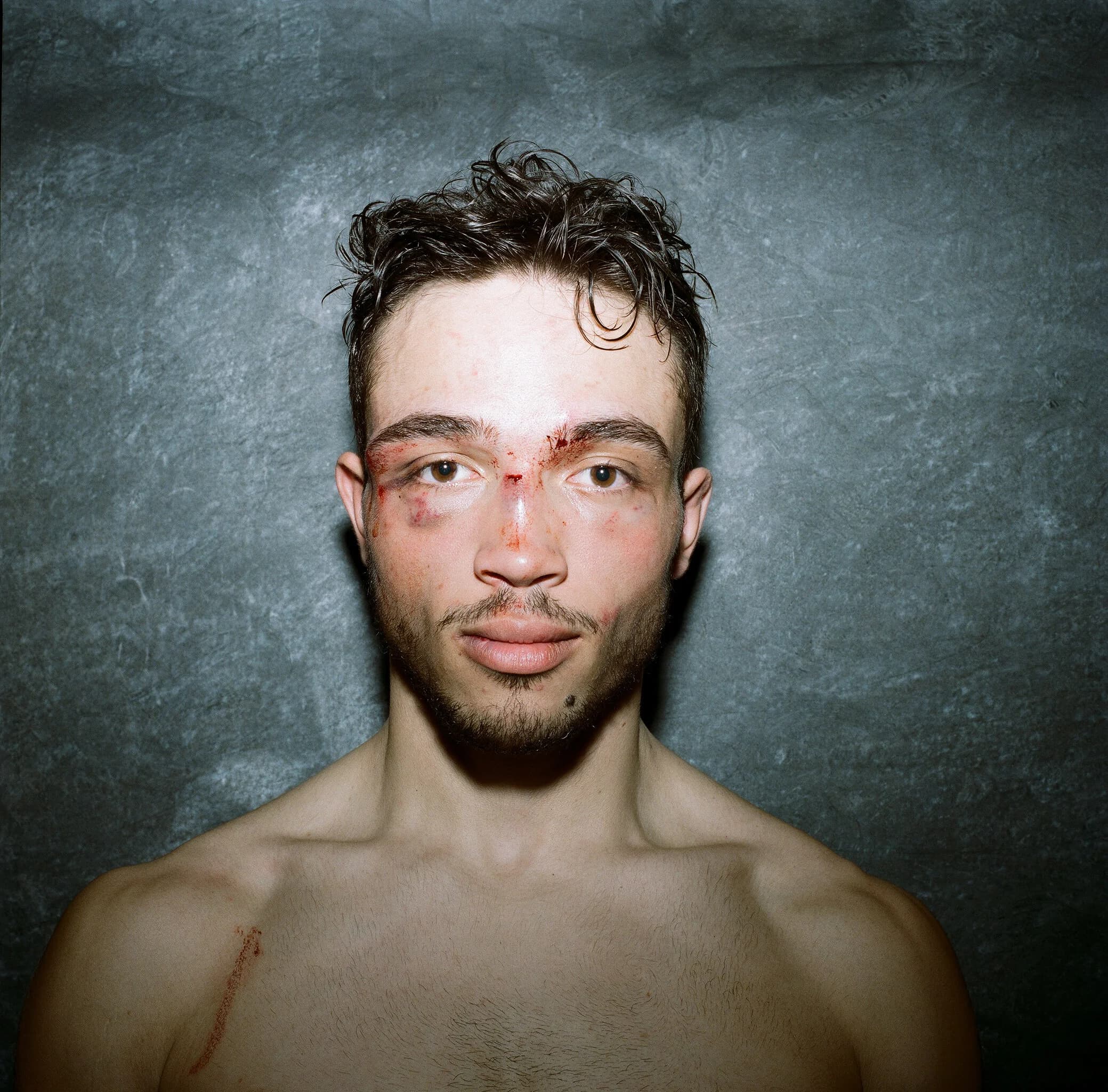 Post-fight portrait of a young fighter with wet curly hair, cuts and fresh bruising around both eyes, meeting the camera with a calm stare